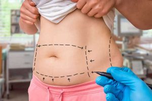 Flat Belly Dreams Come True: Discover the Magic of Tummy Tuck in Dubai