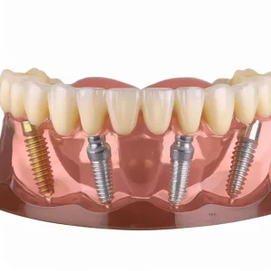 Why Dental Implants Are the Gold Standard for Replacing Missing Teeth